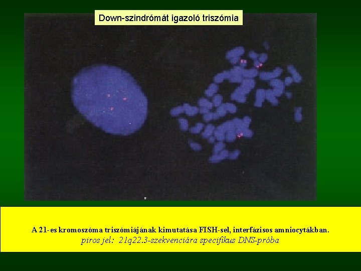 Down-szindrómát igazoló triszómia A 21 -es kromoszóma triszómiájának kimutatása FISH-sel, interfázisos amniocytákban. piros jel: