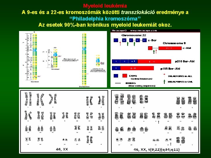 Myeloid leukémia A 9 -es és a 22 -es kromoszómák közötti transzlokáció eredménye a