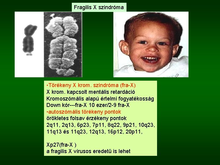 Fragilis X szindróma • Törékeny X krom. szindróma (fra-X) X krom. kapcsolt mentális retardáció