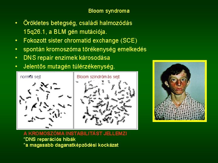 Bloom syndroma • Örökletes betegség, családi halmozódás 15 q 26. 1, a BLM gén