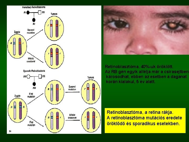  Retinoblasztóma. 40%-uk öröklött. Az RB gén egyik allélja már a csirasejtben károsodhat, ebben