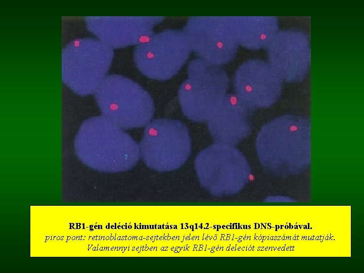  RB 1 -gén deléció kimutatása 13 q 14. 2 -specifikus DNS-próbával. piros pont: