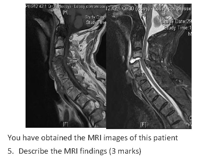 You have obtained the MRI images of this patient 5. Describe the MRI findings