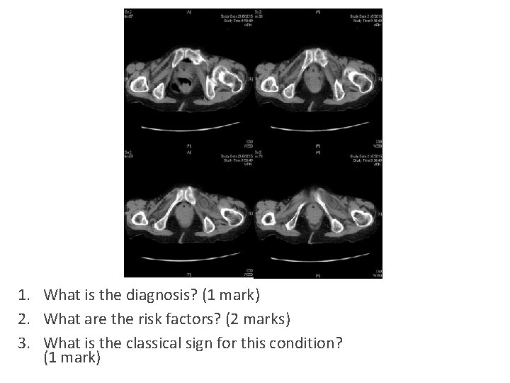 1. What is the diagnosis? (1 mark) 2. What are the risk factors? (2