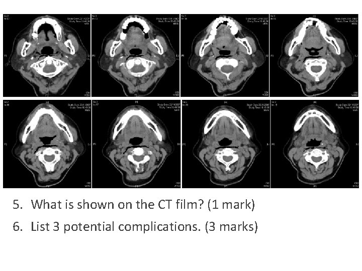 5. What is shown on the CT film? (1 mark) 6. List 3 potential