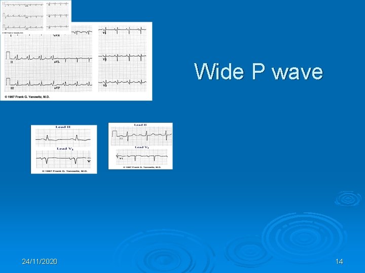 Wide P wave 24/11/2020 14 