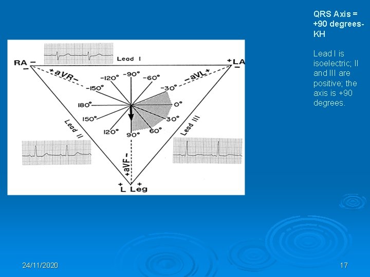 QRS Axis = +90 degrees. KH Lead I is isoelectric; II and III are