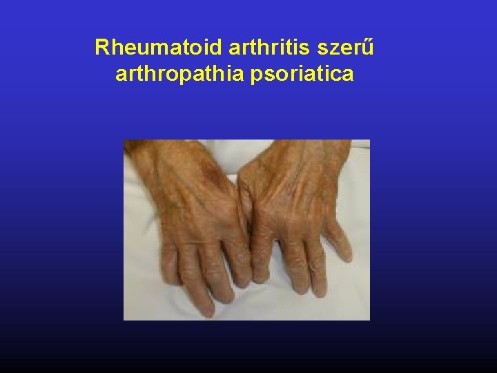 rheumatoid arthritisben nehéz fogyni