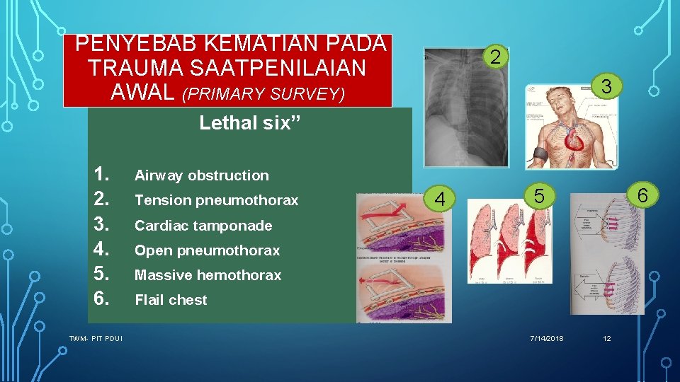 PENYEBAB KEMATIAN PADA TRAUMA SAATPENILAIAN AWAL (PRIMARY SURVEY) 2 3 Lethal six” 1. 2.