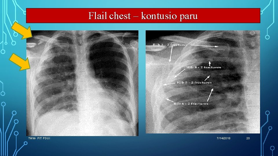 Flail chest – kontusio paru TWM- PIT PDUI 7/14/2018 20 