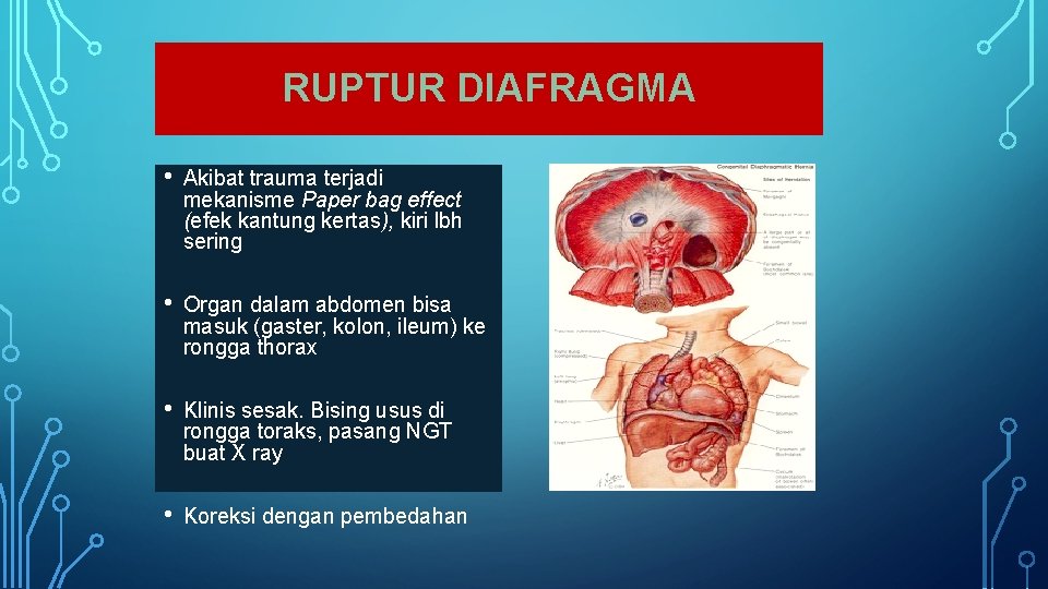 RUPTUR DIAFRAGMA • Akibat trauma terjadi mekanisme Paper bag effect (efek kantung kertas), kiri