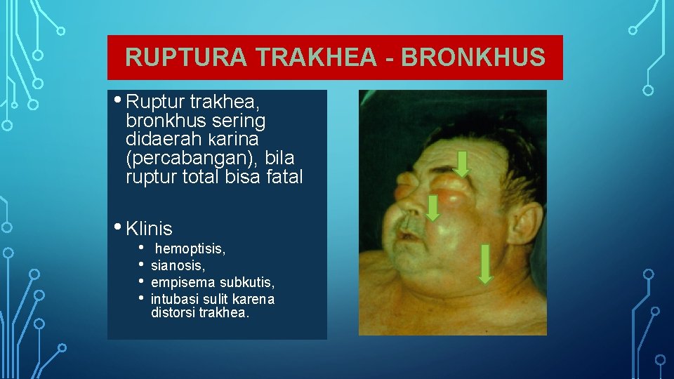 RUPTURA TRAKHEA - BRONKHUS • Ruptur trakhea, bronkhus sering didaerah karina (percabangan), bila ruptur