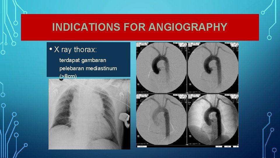 INDICATIONS FOR ANGIOGRAPHY • X ray thorax: terdapat gambaran pelebaran mediastinum (>8 cm) 