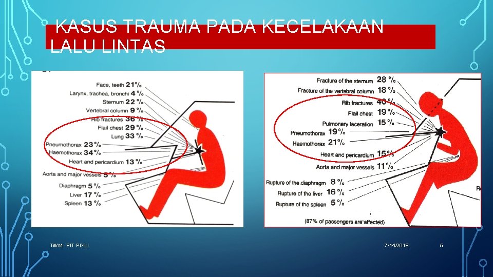 KASUS TRAUMA PADA KECELAKAAN LALU LINTAS TWM- PIT PDUI 7/14/2018 5 