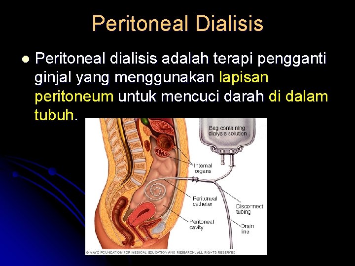 Peritoneal Dialisis l Peritoneal dialisis adalah terapi pengganti ginjal yang menggunakan lapisan peritoneum untuk