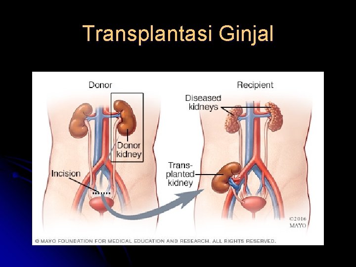 Transplantasi Ginjal 