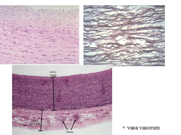 + vasa vasorum 