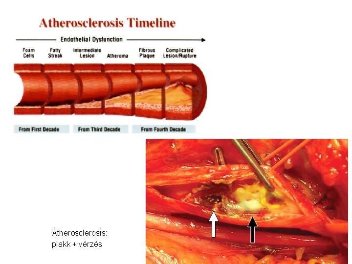 Atherosclerosis: plakk + vérzés 
