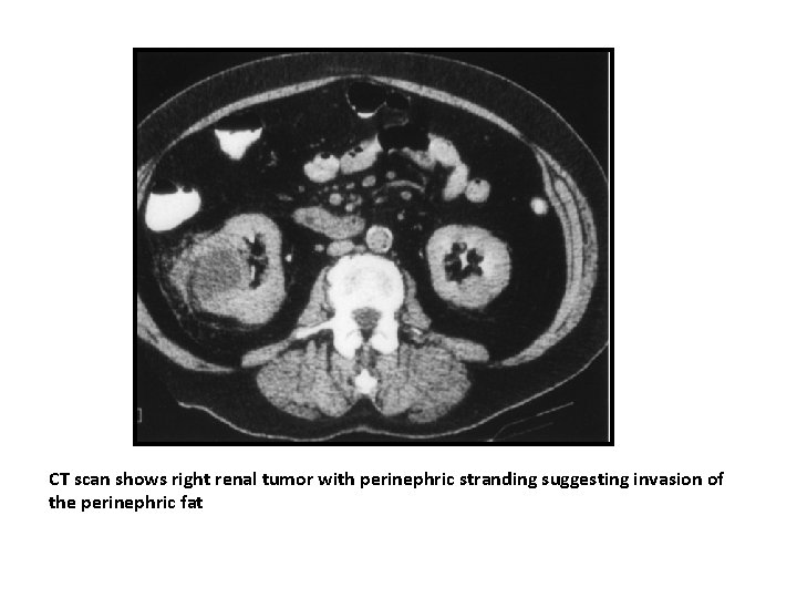 CT scan shows right renal tumor with perinephric stranding suggesting invasion of the perinephric