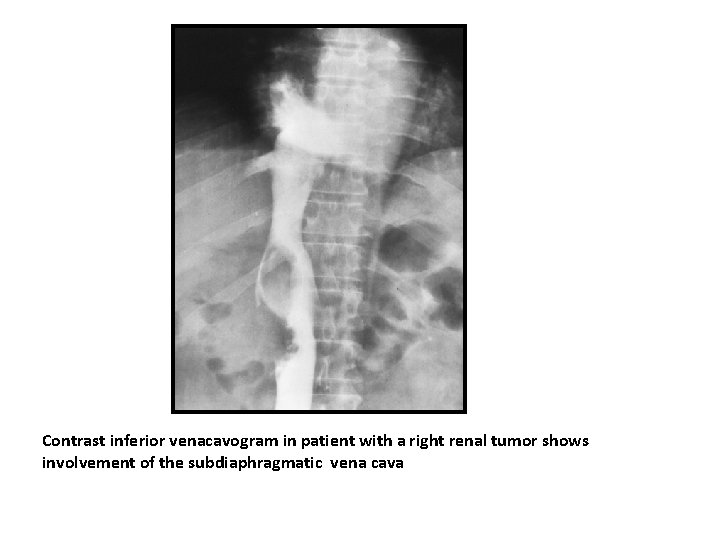 Contrast inferior venacavogram in patient with a right renal tumor shows involvement of the