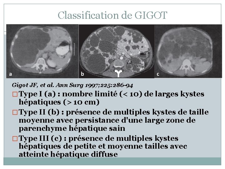 Classification de GIGOT Gigot JF, et al. Ann Surg 1997; 225: 286 -94 �