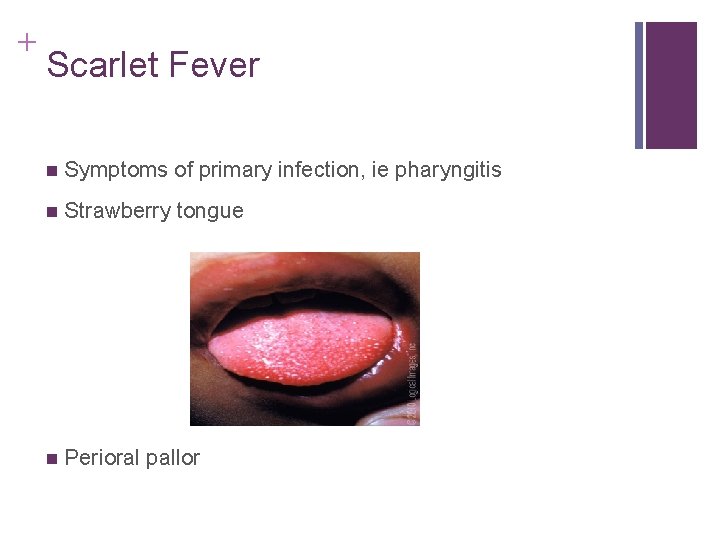 + Scarlet Fever n Symptoms of primary infection, ie pharyngitis n Strawberry tongue n + Scarlet Fever n Symptoms of primary infection, ie pharyngitis n Strawberry tongue n