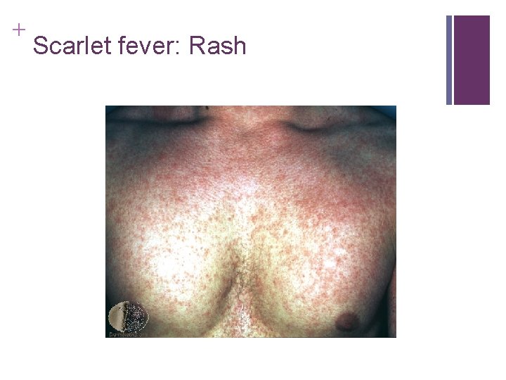 + Scarlet fever: Rash + Scarlet fever: Rash