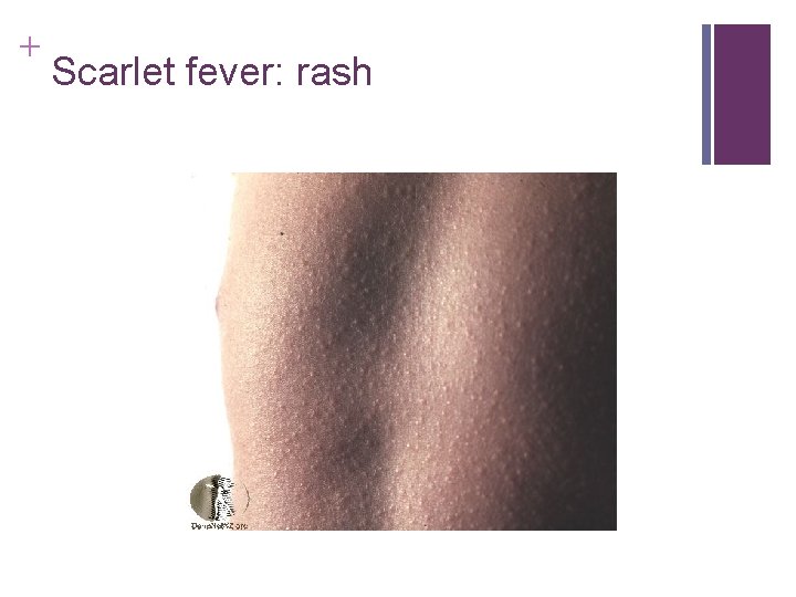 + Scarlet fever: rash + Scarlet fever: rash