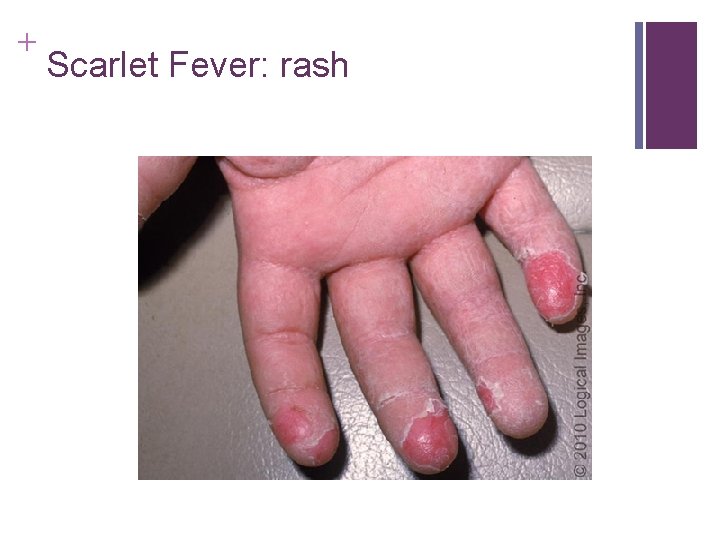 + Scarlet Fever: rash + Scarlet Fever: rash