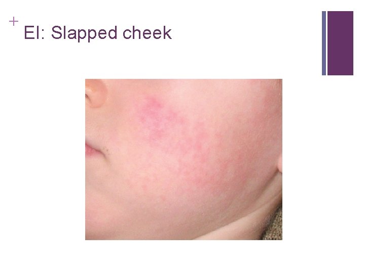 + EI: Slapped cheek + EI: Slapped cheek