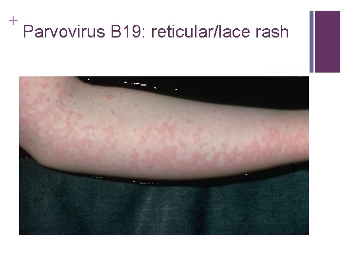 + Parvovirus B 19: reticular/lace rash + Parvovirus B 19: reticular/lace rash