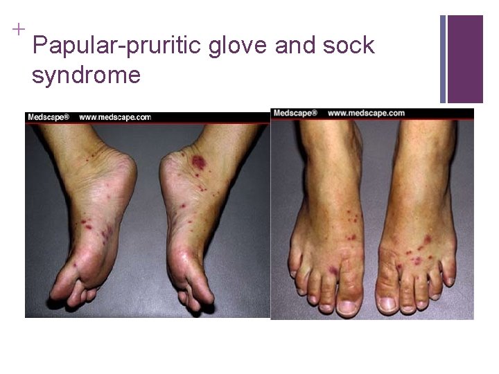 + Papular-pruritic glove and sock syndrome + Papular-pruritic glove and sock syndrome