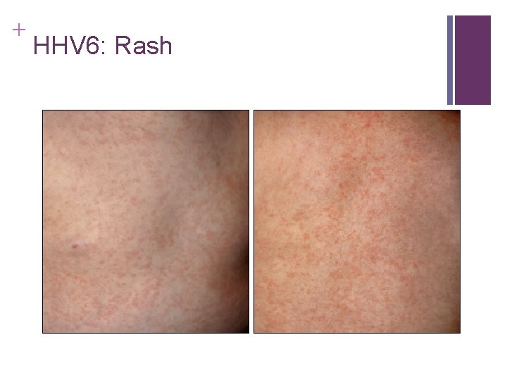 + HHV 6: Rash + HHV 6: Rash