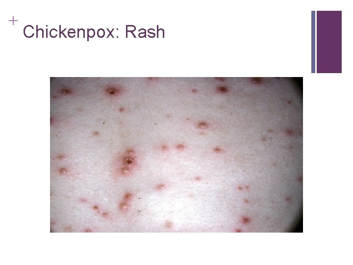 + Chickenpox: Rash + Chickenpox: Rash