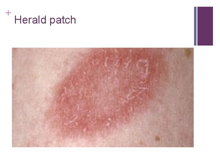 + Herald patch + Herald patch