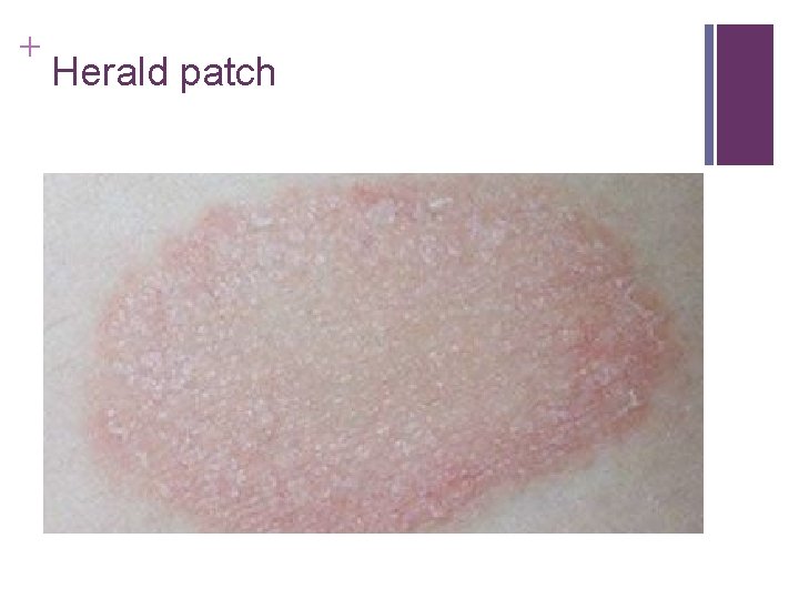 + Herald patch + Herald patch