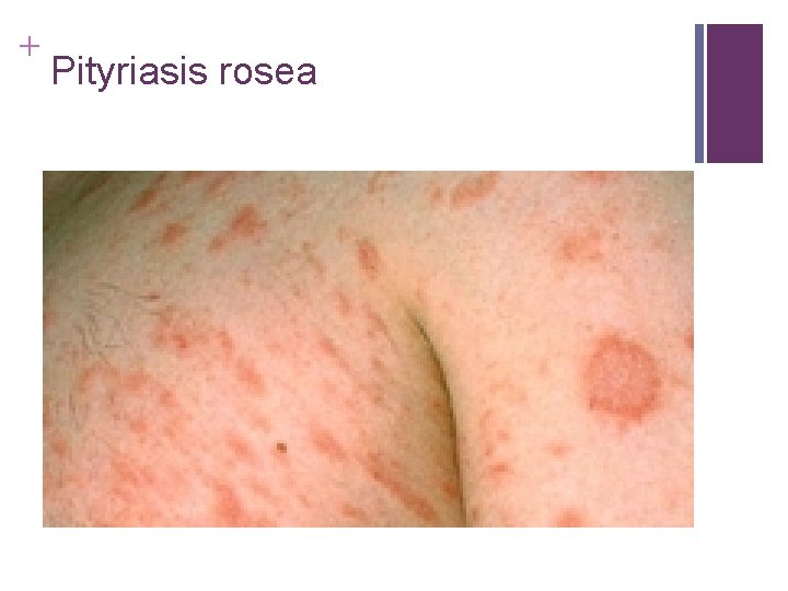 + Pityriasis rosea + Pityriasis rosea