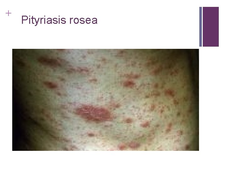 + Pityriasis rosea + Pityriasis rosea