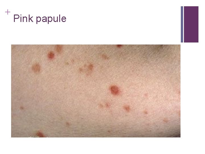 + Pink papule + Pink papule