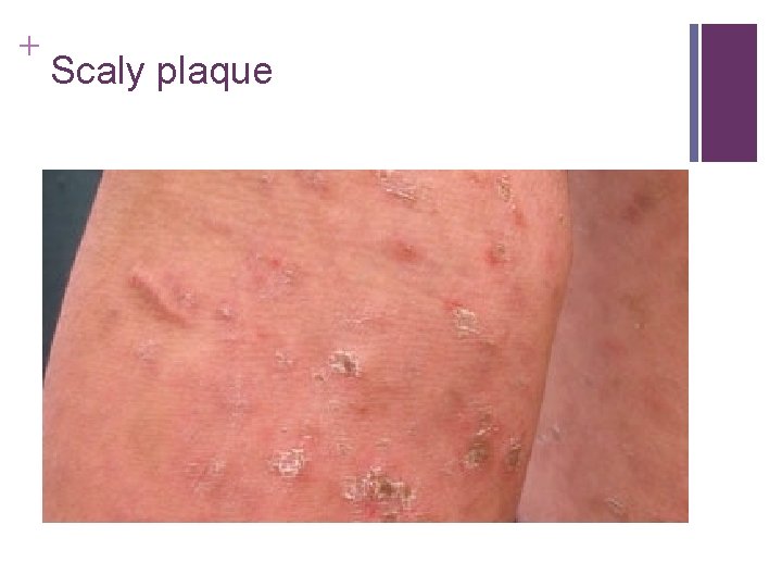 + Scaly plaque + Scaly plaque