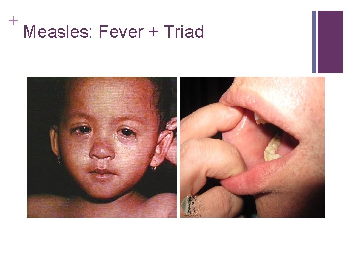 + Measles: Fever + Triad + Measles: Fever + Triad