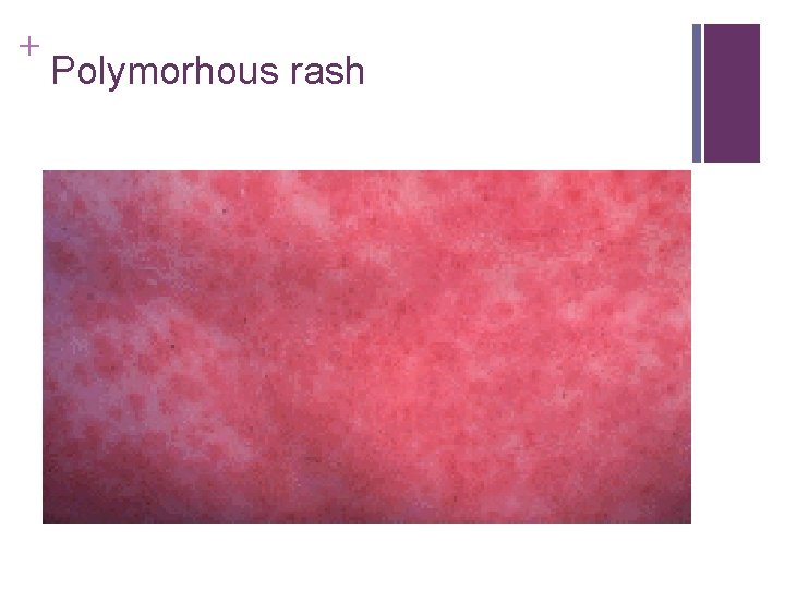 + Polymorhous rash + Polymorhous rash