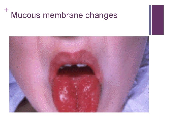 + Mucous membrane changes + Mucous membrane changes
