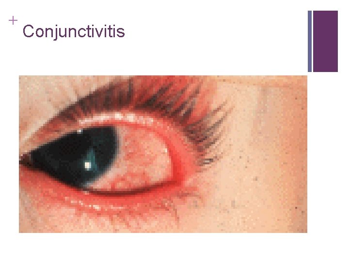 + Conjunctivitis + Conjunctivitis