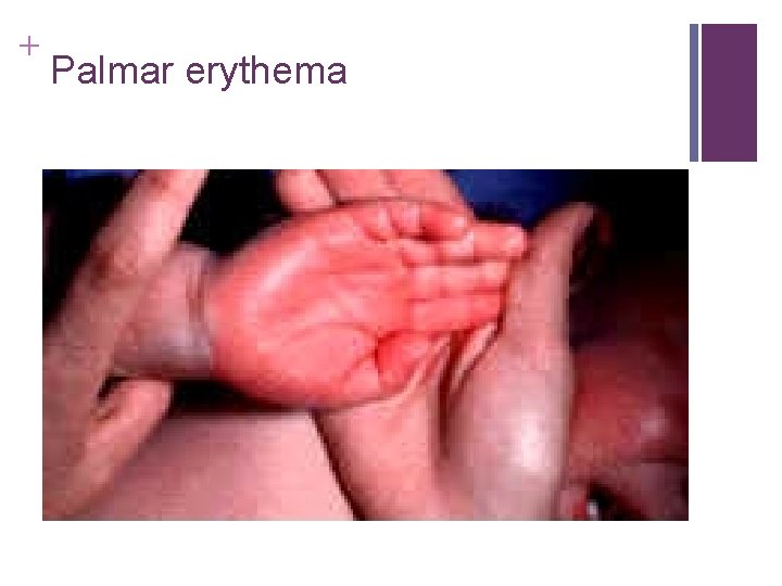 + Palmar erythema + Palmar erythema