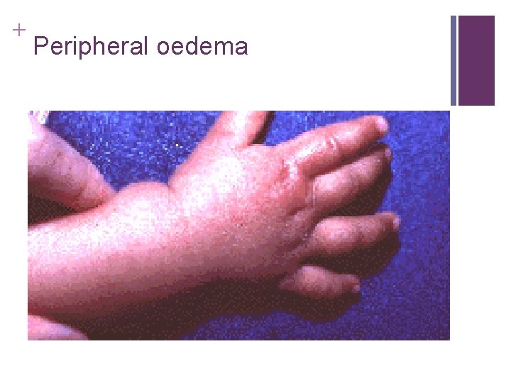 + Peripheral oedema + Peripheral oedema