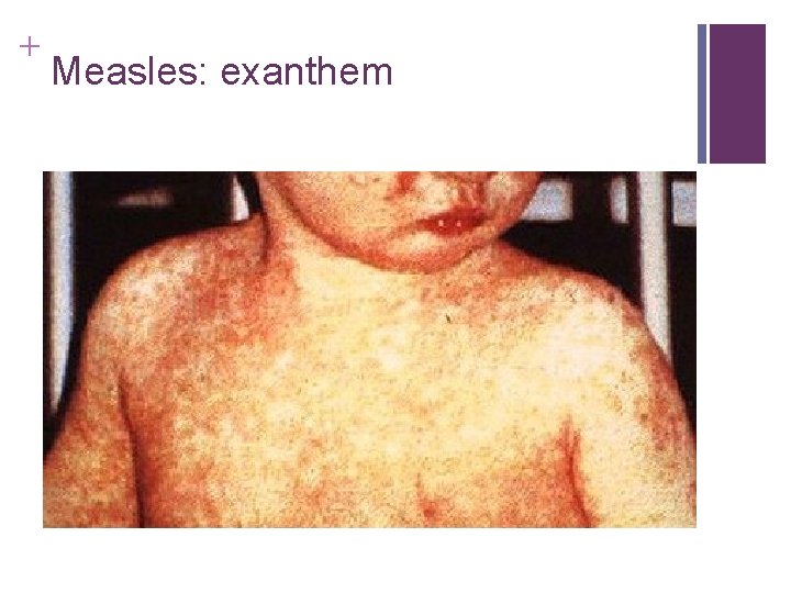 + Measles: exanthem + Measles: exanthem