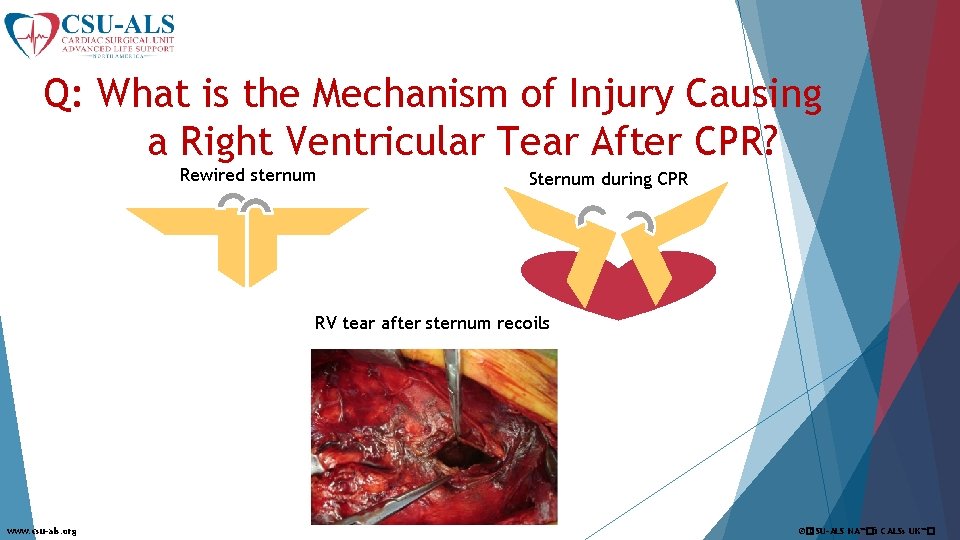 Q: What is the Mechanism of Injury Causing a Right Ventricular Tear After CPR?