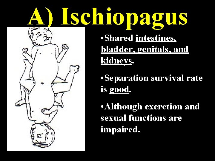 A) Ischiopagus • Shared intestines, bladder, genitals, and kidneys. • Separation survival rate is A) Ischiopagus • Shared intestines, bladder, genitals, and kidneys. • Separation survival rate is