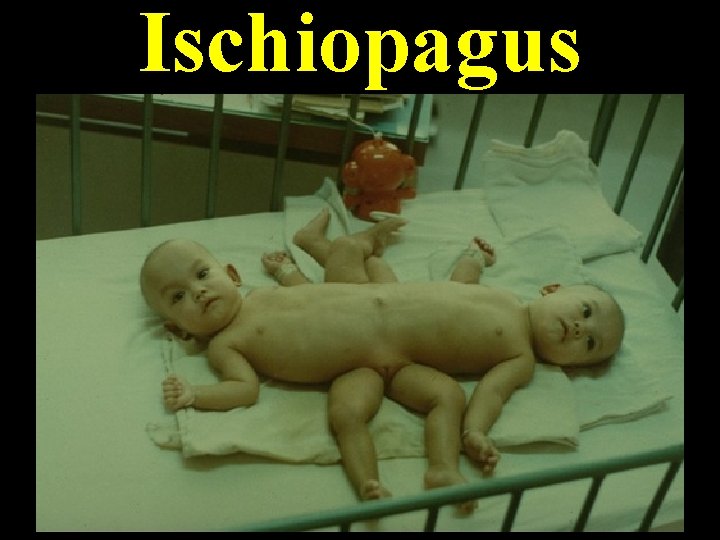 Ischiopagus Ischiopagus